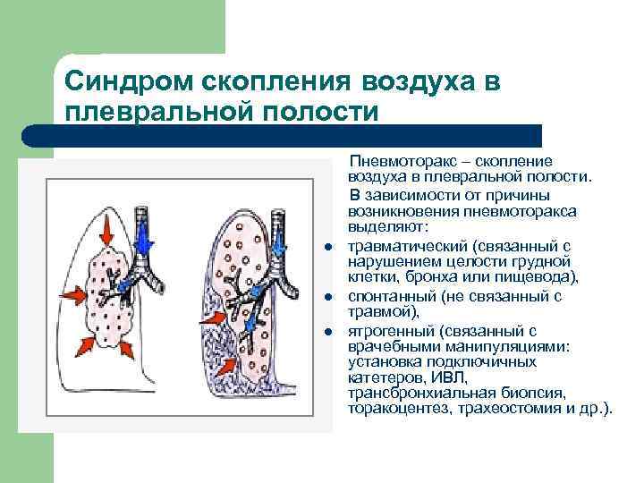 Синдром скопления воздуха в плевральной полости l l l Пневмоторакс – скопление воздуха в