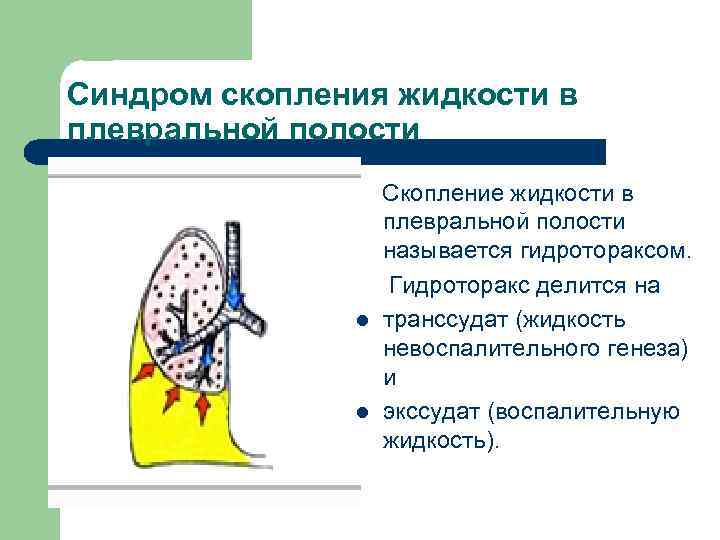 Синдром скопления жидкости в плевральной полости l l Скопление жидкости в плевральной полости называется