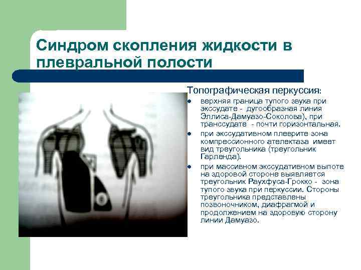 Синдром скопления жидкости в плевральной полости Топографическая перкуссия: l l l верхняя граница тупого