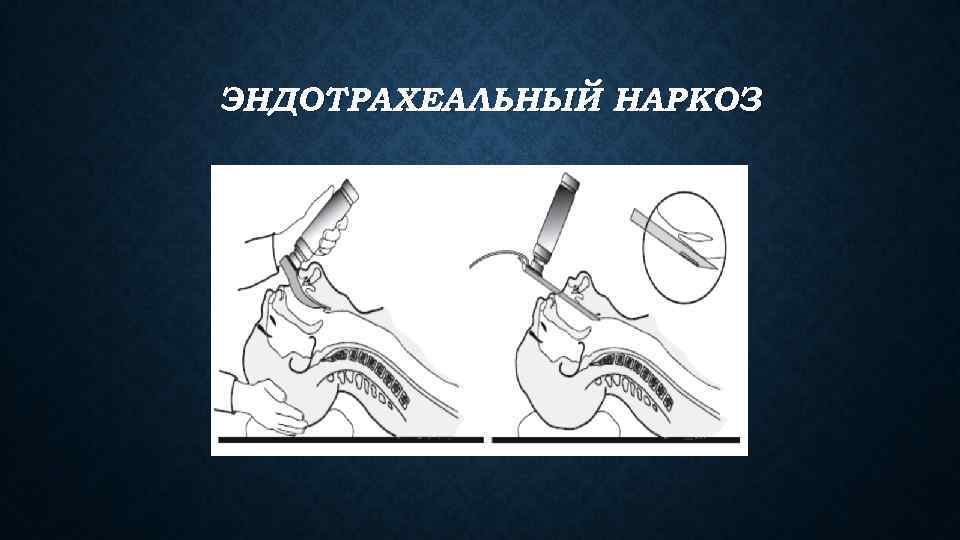 ЭНДОТРАХЕАЛЬНЫЙ НАРКОЗ 