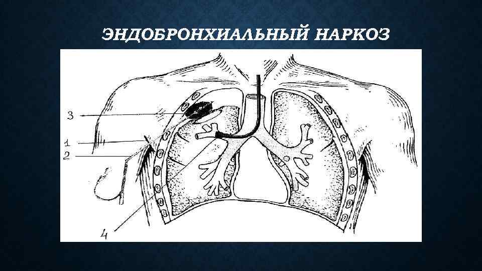 ЭНДОБРОНХИАЛЬНЫЙ НАРКОЗ 