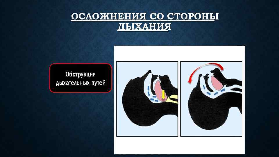 ОСЛОЖНЕНИЯ СО СТОРОНЫ ДЫХАНИЯ Обструкция дыхательных путей 