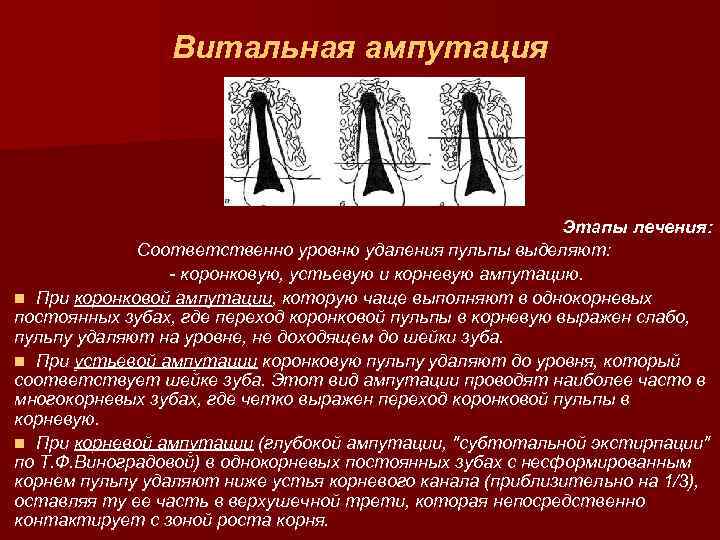 Витальная ампутация Этапы лечения: Соответственно уровню удаления пульпы выделяют: - коронковую, устьевую и корневую