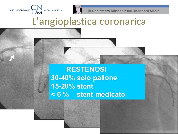 L’angioplastica coronarica RESTENOSI 30 -40% solo pallone 15 -20% stent < 6 % stent