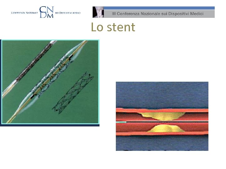 Lo stent 