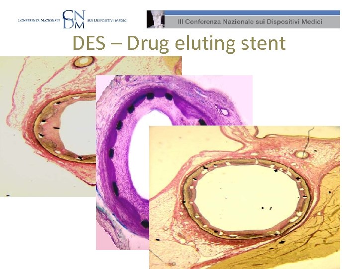 DES – Drug eluting stent 
