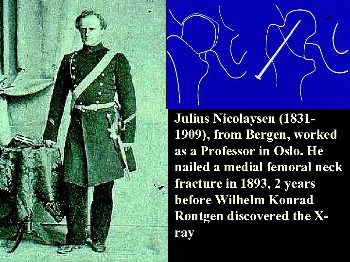 Julius Nicolaysen (18311909), from Bergen, worked as a Professor in Oslo. He nailed a