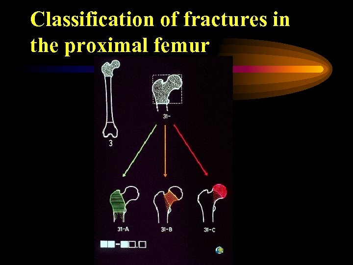 Classification of fractures in the proximal femur 