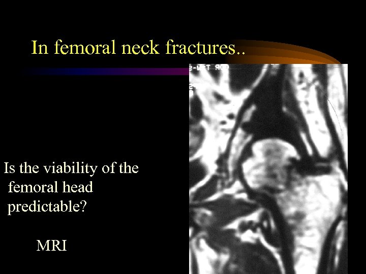 In femoral neck fractures. . Is the viability of the femoral head predictable? MRI