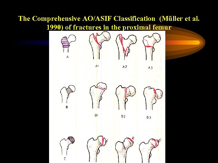 Fractures Of The Femoral Neck And Intertrochanteric Fractures