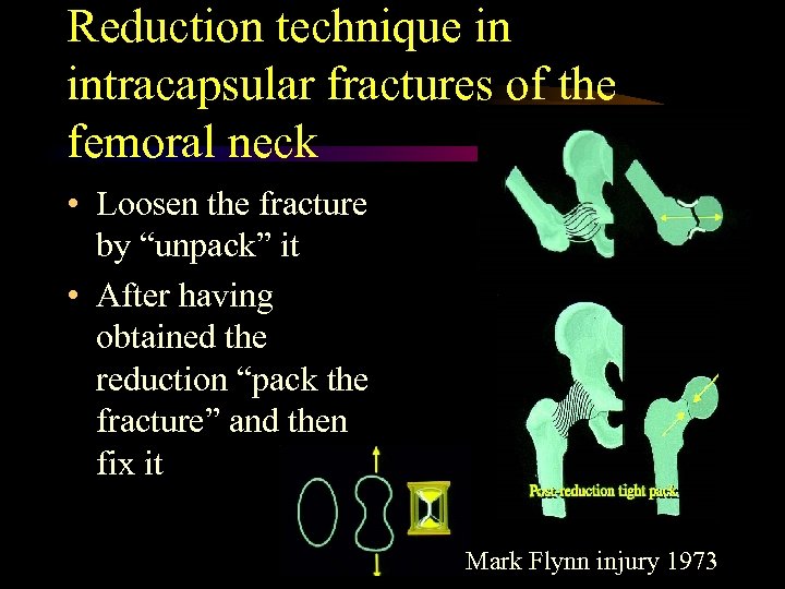 Reduction technique in intracapsular fractures of the femoral neck • Loosen the fracture by