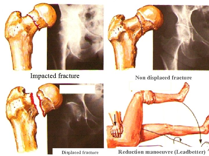 Impacted fracture Non displaced fracture Impacted fracture Displaced fracture Reduction manoeuvre (Leadbetter) 