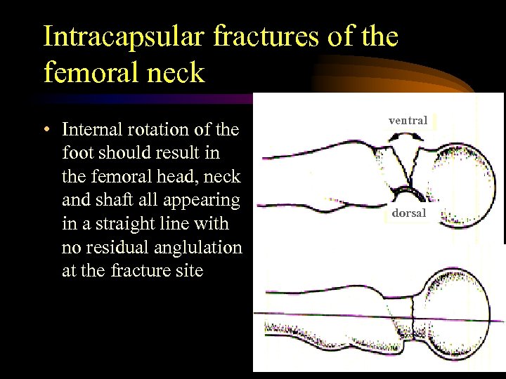 Intracapsular fractures of the femoral neck • Internal rotation of the foot should result