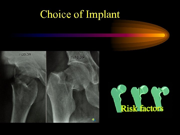 Choice of Implant 