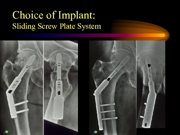 Choice of Implant: Sliding Screw Plate System 