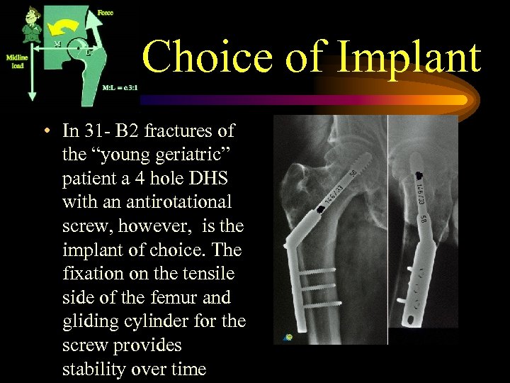 Choice of Implant • In 31 - B 2 fractures of the “young geriatric”