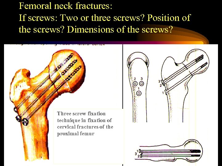Femoral neck fractures: If screws: Two or three screws? Position of the screws? Dimensions