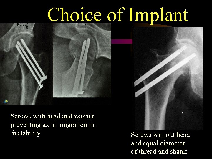 Choice of Implant Screws with head and washer preventing axial migration in instability Screws