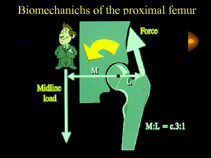 Biomechanichs of the proximal femur 
