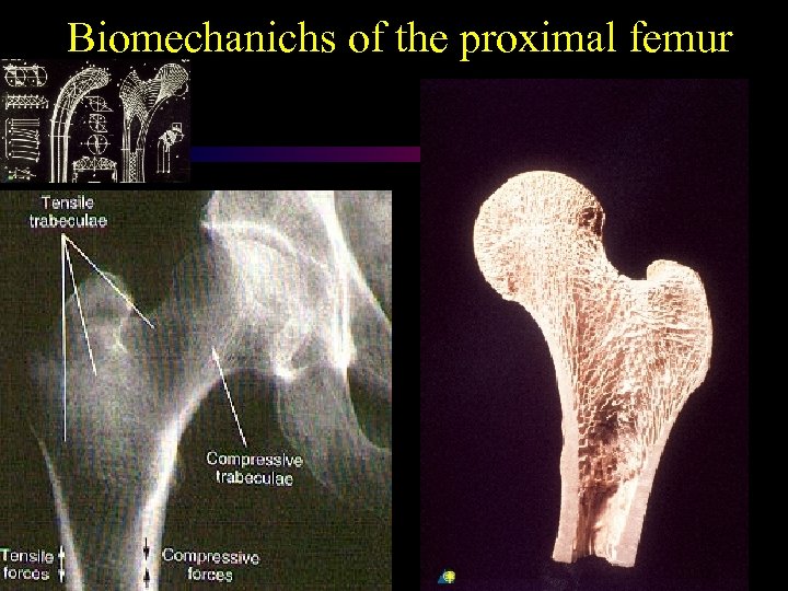 Biomechanichs of the proximal femur 