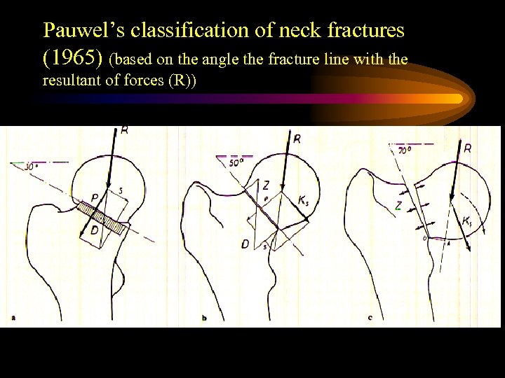 Pauwel’s classification of neck fractures (1965) (based on the angle the fracture line with
