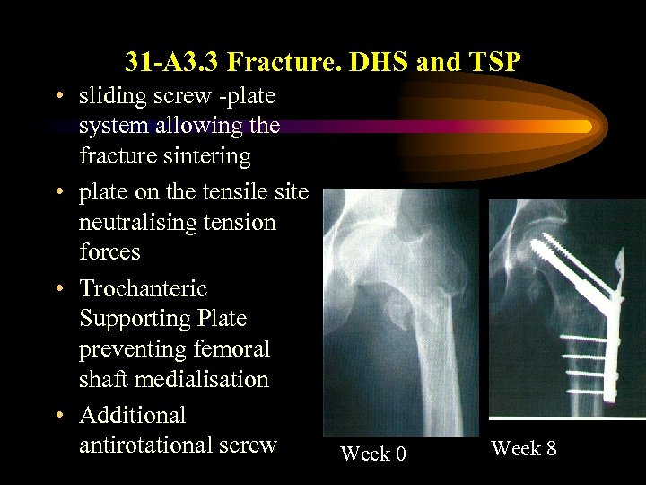 31 -A 3. 3 Fracture. DHS and TSP • sliding screw -plate system allowing