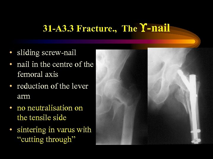 31 -A 3. 3 Fracture. , The -nail • sliding screw-nail • nail in