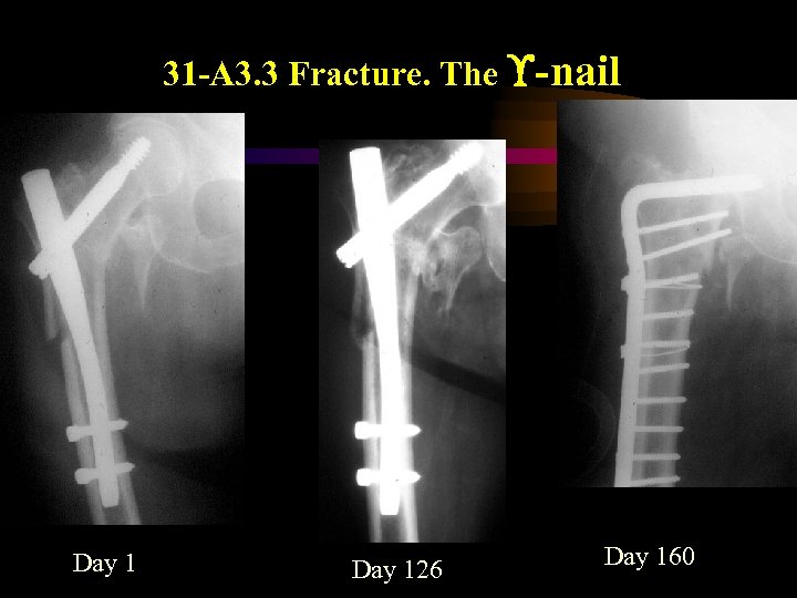 31 -A 3. 3 Fracture. The -nail Day 126 Day 160 