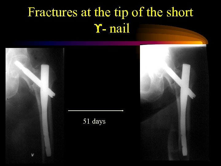 Fractures at the tip of the short - nail 51 days 