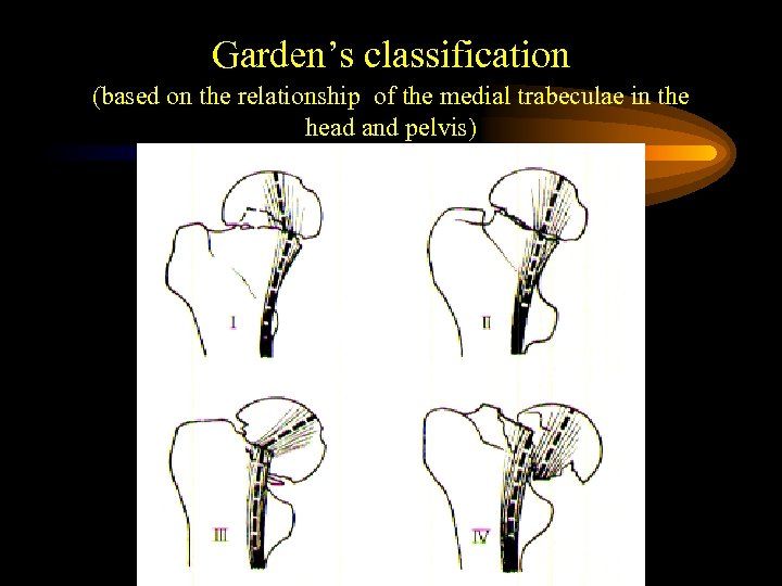 Garden’s classification (based on the relationship of the medial trabeculae in the head and