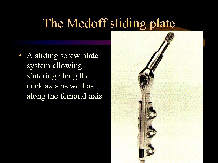 The Medoff sliding plate • A sliding screw plate system allowing sintering along the