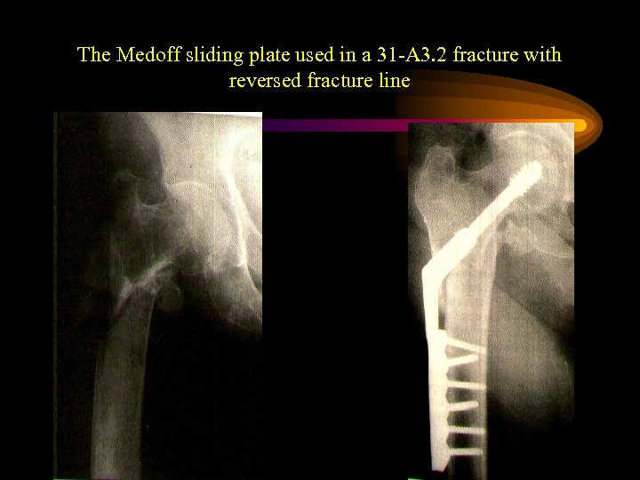 The Medoff sliding plate used in a 31 -A 3. 2 fracture with reversed