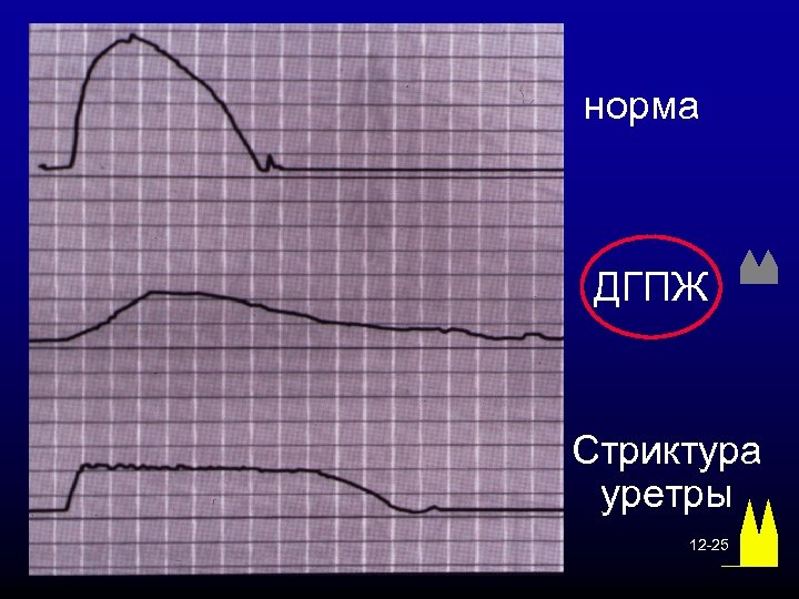 норма ДГПЖ Стриктура уретры 12 -25 