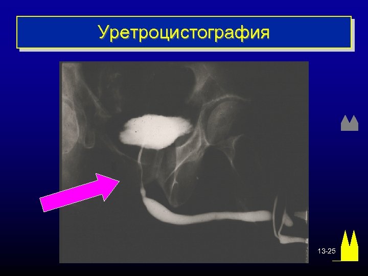 Уретроцистография 13 -25 