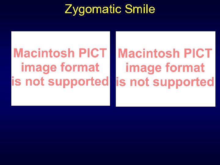 Zygomatic Smile 