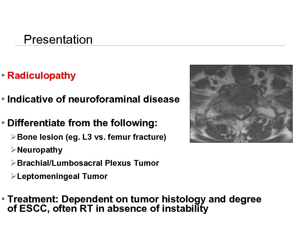 Presentation • Radiculopathy • Indicative of neuroforaminal disease • Differentiate from the following: ØBone