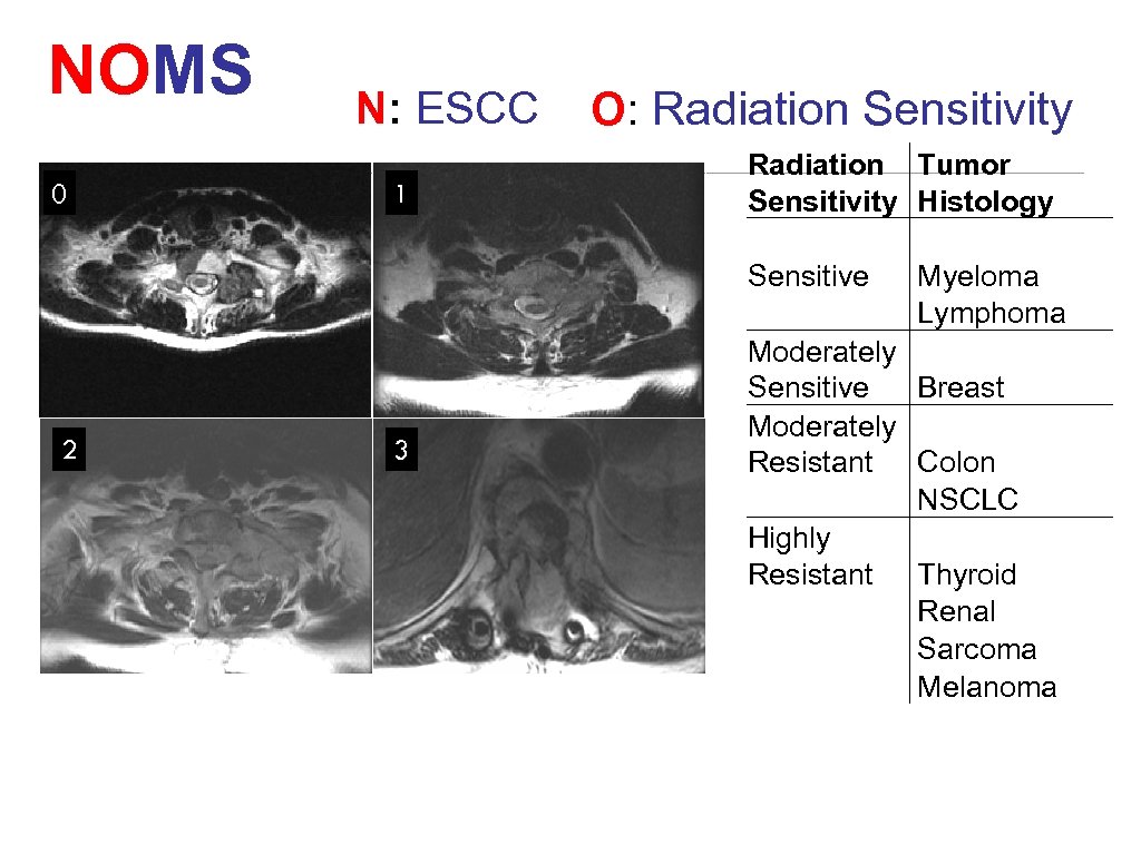 NOMS N: ESCC 0 2 1 3 O: Radiation Sensitivity Radiation Tumor Sensitivity Histology