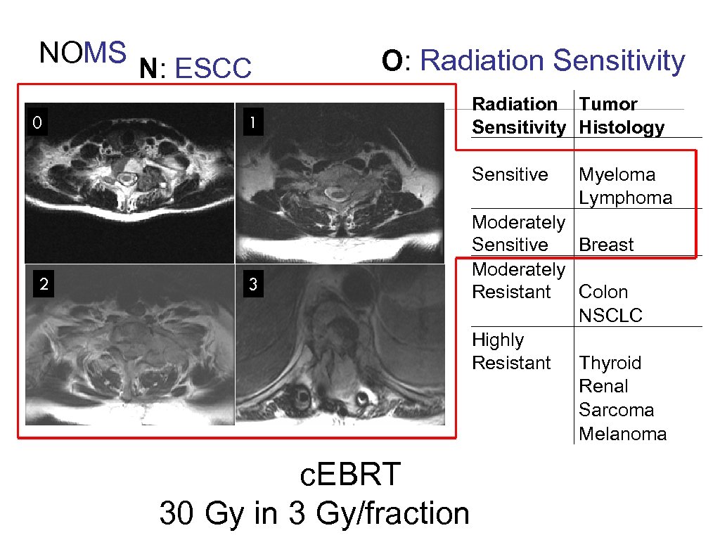 NOMS N: ESCC 0 2 O: Radiation Sensitivity 1 3 c. EBRT 30 Gy