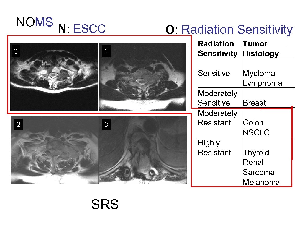 NOMS N: ESCC 0 2 1 3 SRS O: Radiation Sensitivity Radiation Tumor Sensitivity