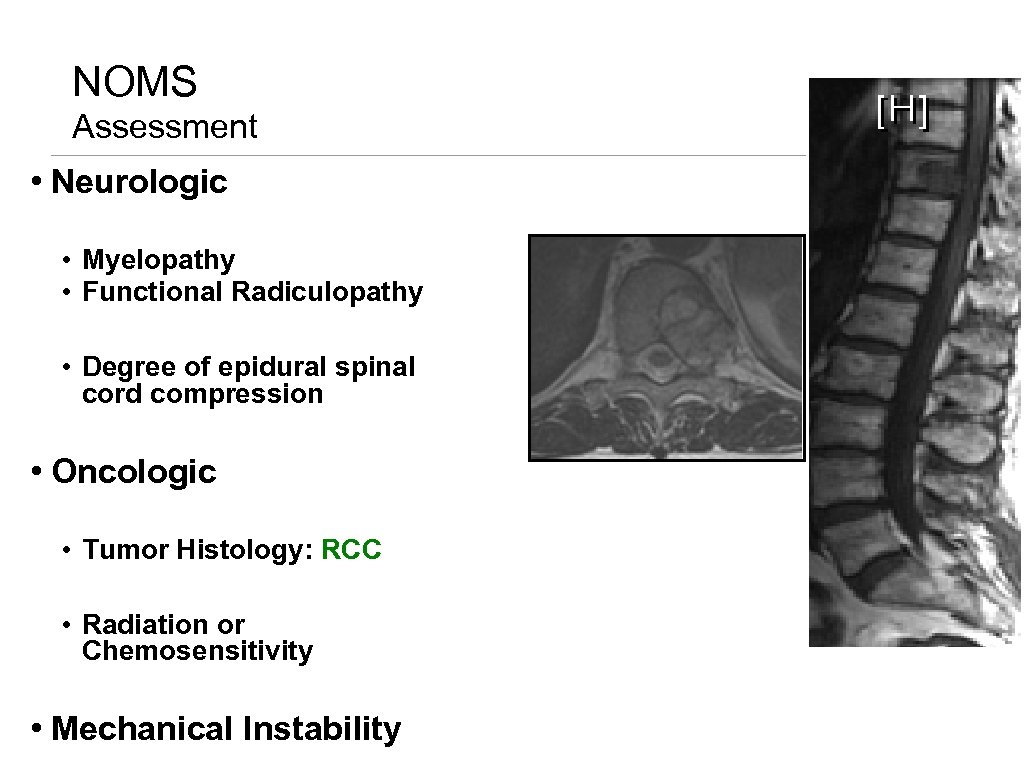 NOMS Assessment • Neurologic • Myelopathy • Functional Radiculopathy • Degree of epidural spinal