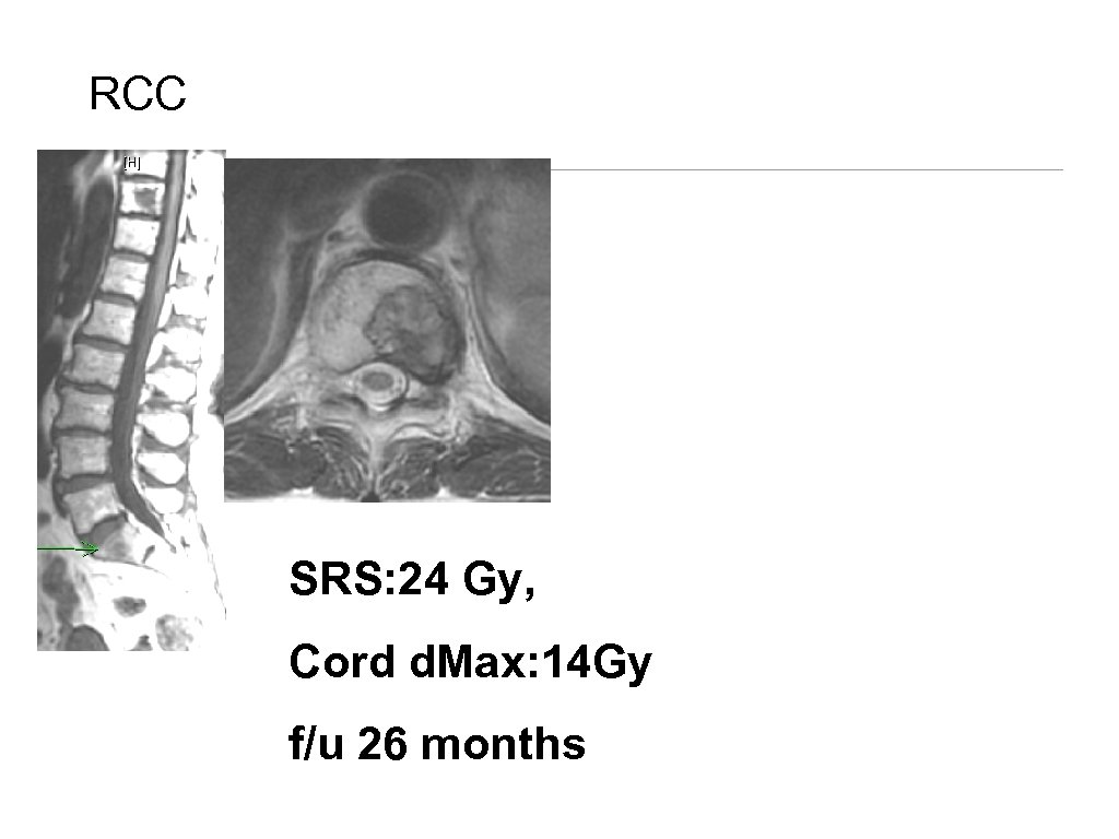 SPINE SBRT The MSKCC Spine Service IAEA Singapore