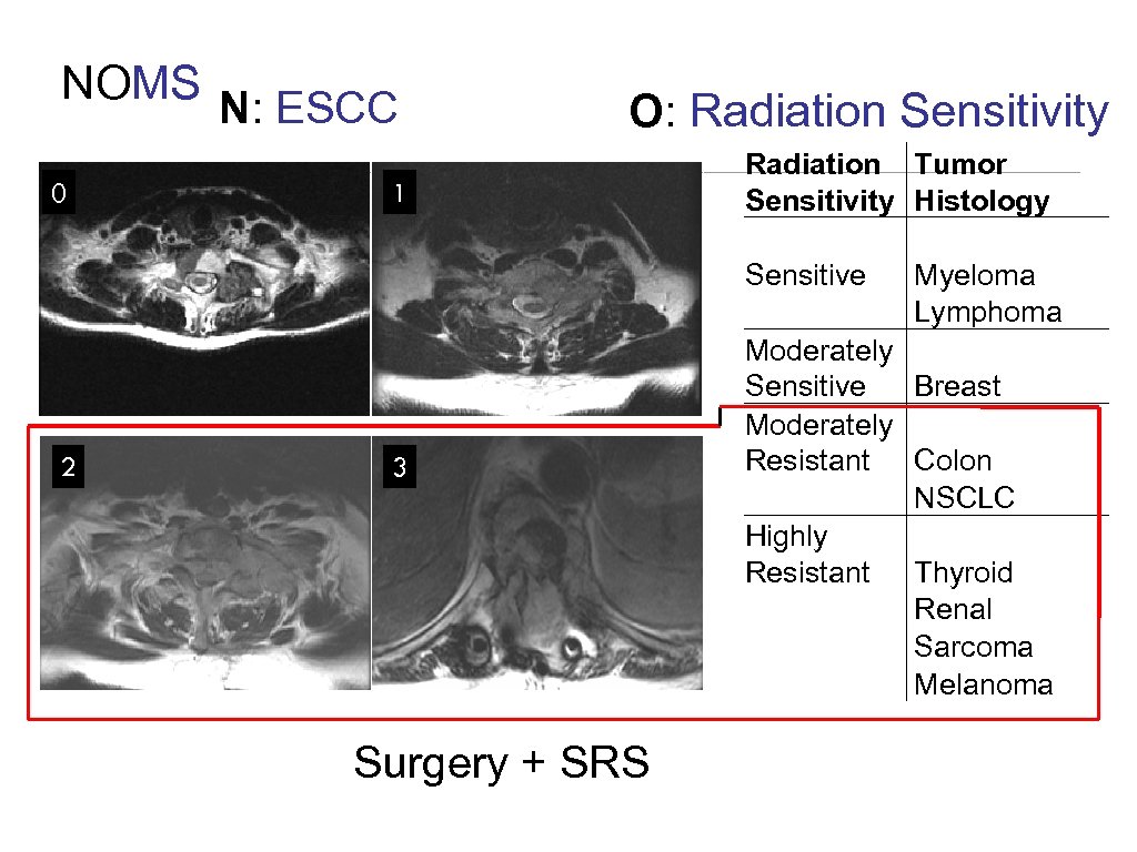 NOMS N: ESCC 0 2 O: Radiation Sensitivity 1 3 Surgery + SRS Radiation