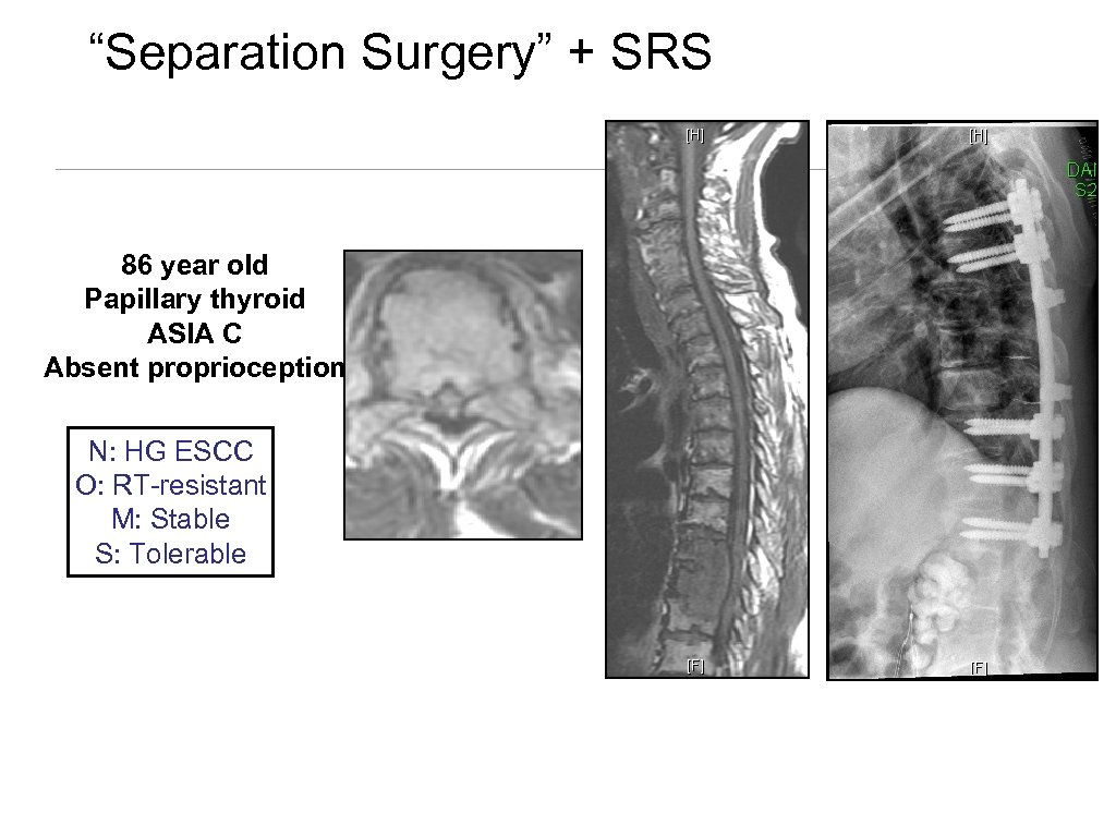 “Separation Surgery” + SRS 86 year old Papillary thyroid ASIA C Absent proprioception N: