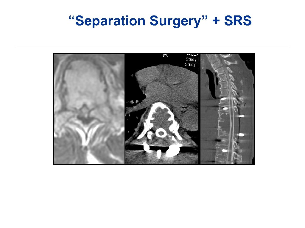 “Separation Surgery” + SRS 