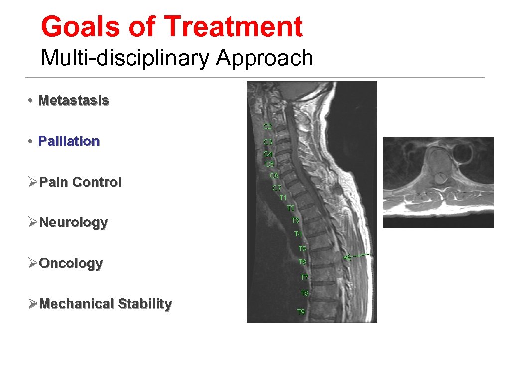 Goals of Treatment Multi-disciplinary Approach • Metastasis • Palliation ØPain Control ØNeurology ØOncology ØMechanical