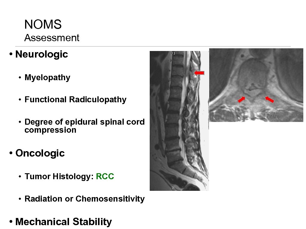 NOMS Assessment • Neurologic • Myelopathy • Functional Radiculopathy • Degree of epidural spinal