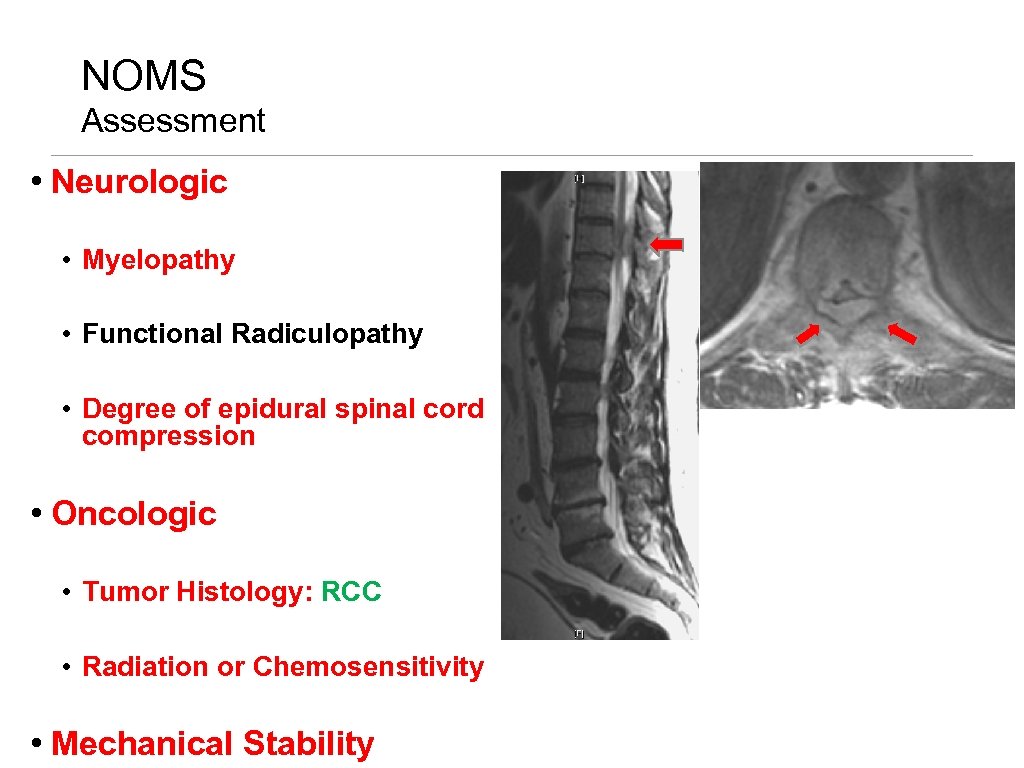 NOMS Assessment • Neurologic • Myelopathy • Functional Radiculopathy • Degree of epidural spinal