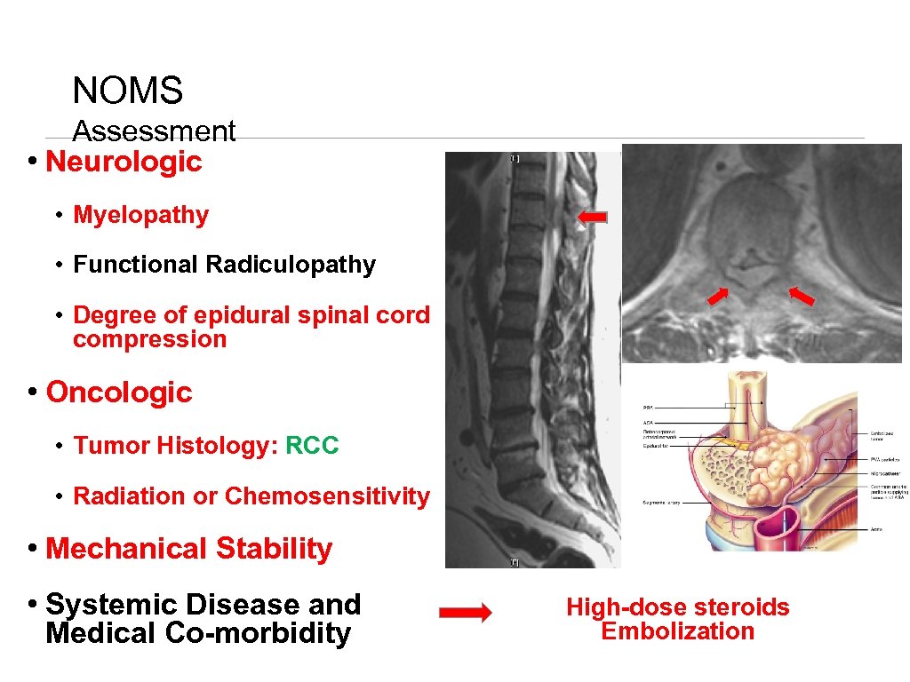 NOMS Assessment • Neurologic • Myelopathy • Functional Radiculopathy • Degree of epidural spinal