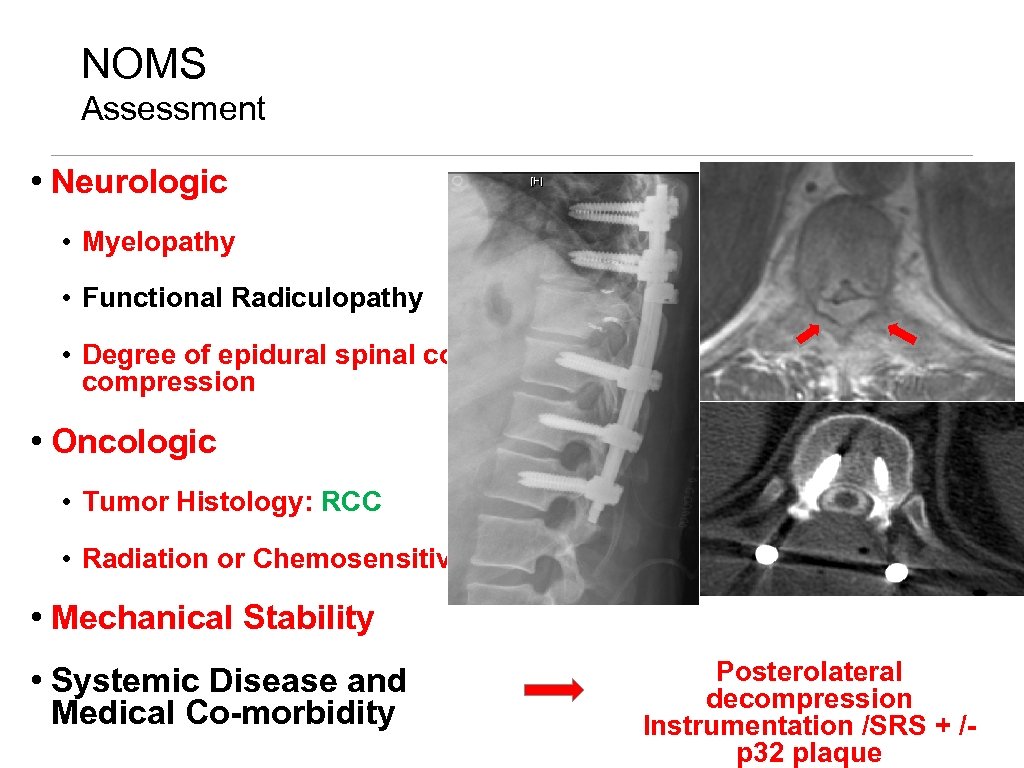 NOMS Assessment • Neurologic • Myelopathy • Functional Radiculopathy • Degree of epidural spinal