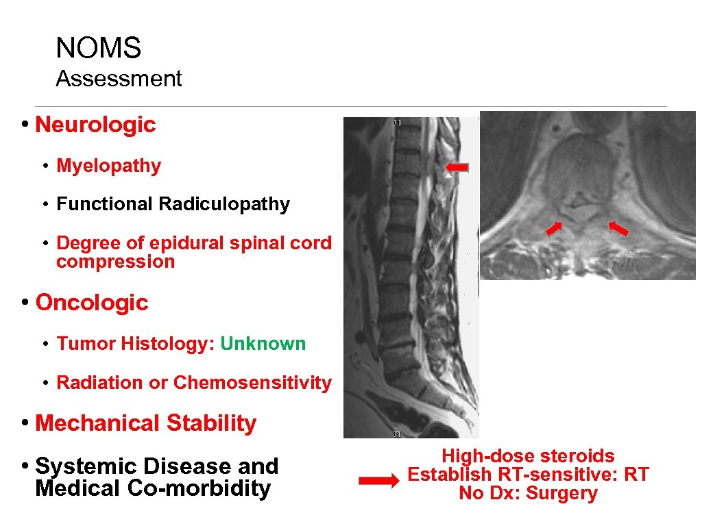 NOMS Assessment • Neurologic • Myelopathy • Functional Radiculopathy • Degree of epidural spinal